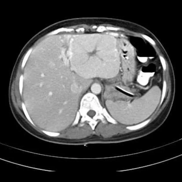 Imagen radiológica de una hiperplasia nodular focal hepática. Se observa su característica cicatriz central.