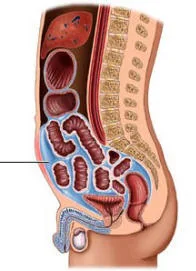 Esquema de la acumulación de líquido en el abdomen (ascitis)