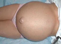 Persona con ascitis: aumento del volumen abdominal por acumulación de líquido
