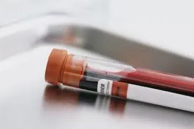 Las transaminasas se miden en un examen de sangre de rutina