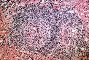 Biopsia hepática de una persona con colangitis biliar primaria, con infiltrado inflamatorio de linfocitos en la región portal y daño del conductillo biliar