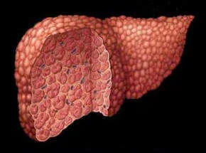 Cirrosis hepática