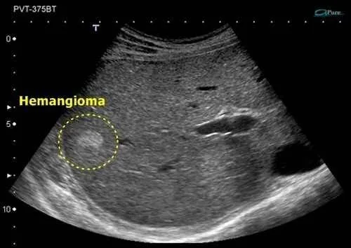 Hemangioma hepático en una imagen de resonancia magnética