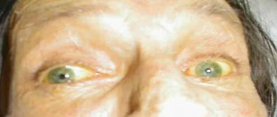 Coloración amarilla de las escleras (el blanco de los ojos) por ictericia